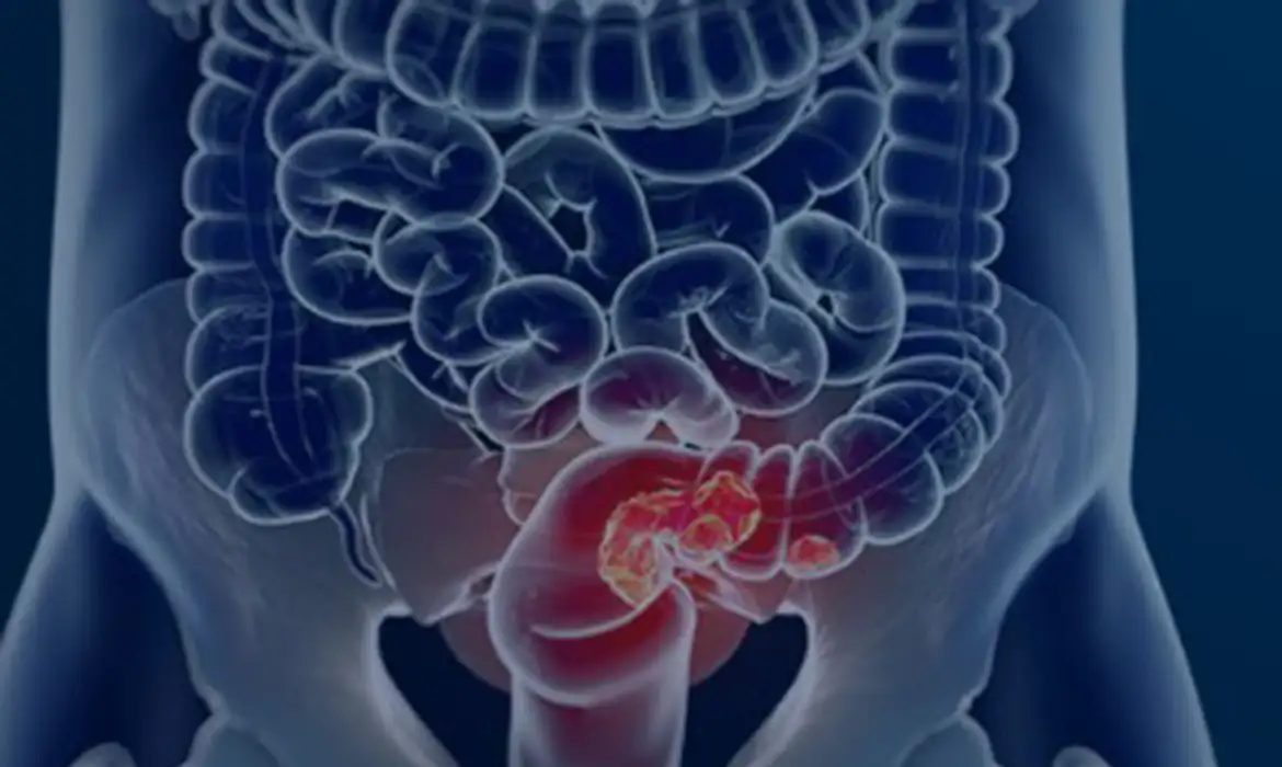 OAB Barro Preto - Estudo projeta aumento de 36% em mortes por câncer colorretal até 2040