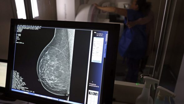 Falta de acesso a mamógrafos limita prevenção do câncer de mama