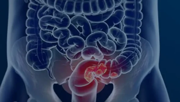 Pacientes com câncer colorretal são diagnosticados em estágio avançado