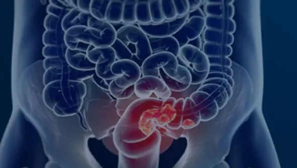 Rastreamento para câncer colorretal pode ser implementado no SUS