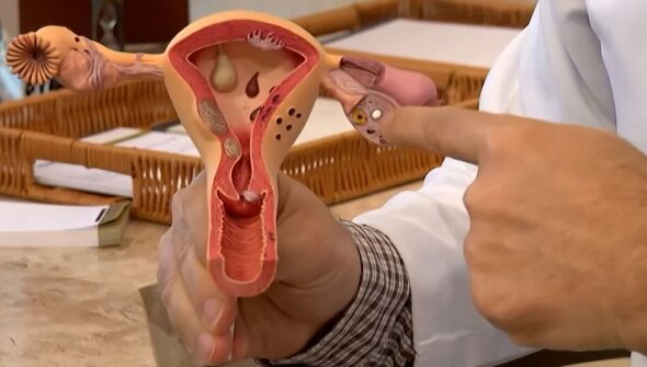 Aberta chamada pública para pesquisas sobre endometriose